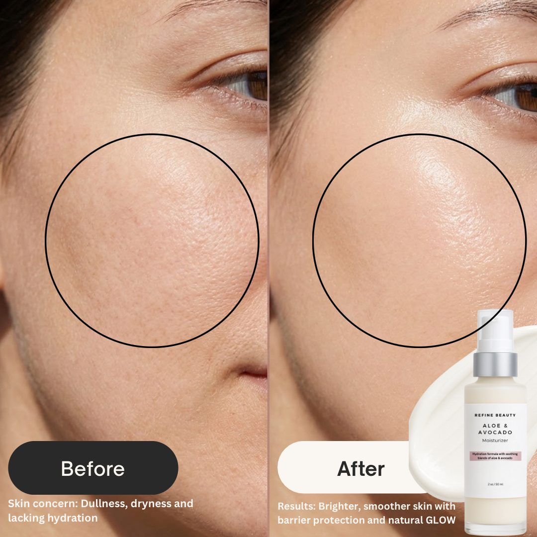 Before and after comparison of skin with Refine Beauty Aloe & Avocado moisturizer 