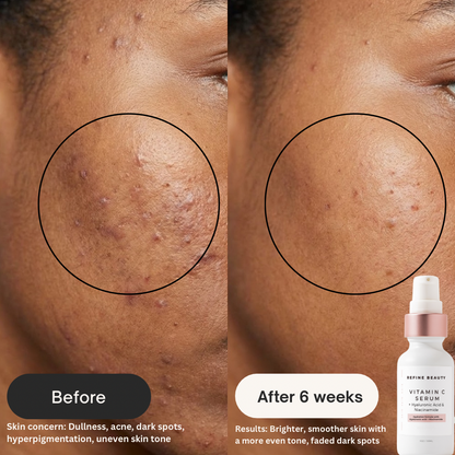 Before and after comparison of Refine Beauty Vitamin C Serum skin treatment with a bottle shown.